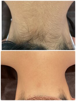 ボニート 堺東店(BONITO)/うなじ脱毛