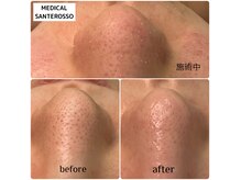 メディカル サンテロッソ(MEDICAL SANTEROSSO)の雰囲気（長年の頑固な毛穴悩み韓国式３D毛穴洗浄におまかせ）