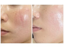 ナオフクオカ ヒーリングフォースエヌ(NaoFukuoka/healingforceN)/ヒト幹細胞マッサージで陶器肌