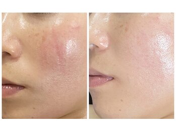 ナオフクオカ ヒーリングフォースエヌ(NaoFukuoka/healingforceN)/ヒト幹細胞マッサージで陶器肌