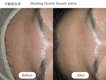 ヒーリングハーツ(Healing Hearts)/年齢肌に逆らうハーブピーリング
