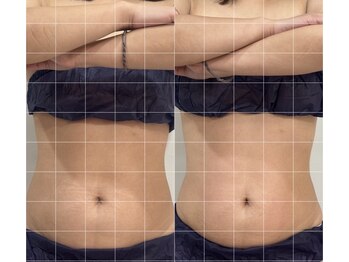 アイ ベル(AI belle)/1回の施術でスッキリ☆