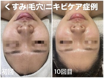 ソフ(soph.)/くすみ症例