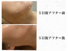 メンズブリリアンス/小顔＆毛穴レス！エイジングケア