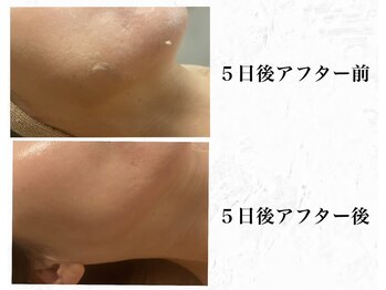 メンズブリリアンス/小顔＆毛穴レス！エイジングケア