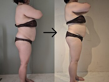 taiON.【ピラティス/温活/よもぎ蒸し】/ハイパーナイフ７一回の施術効果