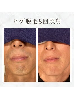 ボゴス(BOGOSS)/ヒゲ脱毛8回照射