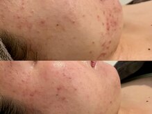 バタフライ 津田沼店(Butterfly)/Butterflyのハーブピーリング