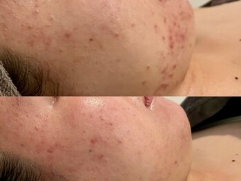 バタフライ 津田沼店(Butterfly)/Butterflyのハーブピーリング