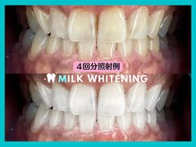ミルクホワイトニング 長崎中央橋店(Milkホワイトニング)/◆施術例
