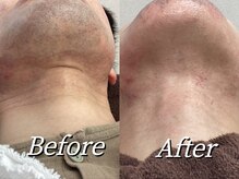 ラ ルアナ(La Luana)の雰囲気（【LED脱毛】毛周期を気にせず照射可能!まだ春夏に間に合います♪）