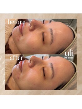 ウリ(uli beauty)/比較写真