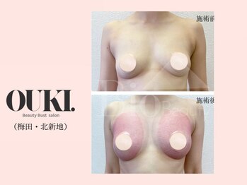 オウキ 梅田北新地(OUKI.)/バストアップ結果写真