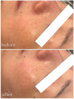 メゾンリュバン 梅田店(Maison Ruban)/ダクトピール｜シミしわ透明感