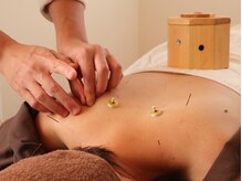 のはり/はり灸施術