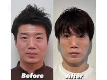コルミチョン サロン(骨美整 salon)/Before(29歳)・After(37歳)