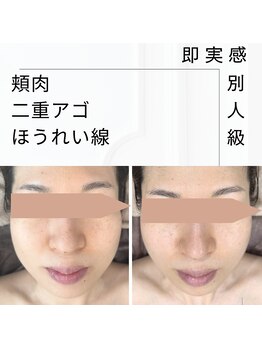 アクアリジェ/レモンボトル導入×小顔矯正1回