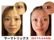 ラディアント たまプラーザの雰囲気（脱老け見え！パーツ別サーマトリックスで目の下のたるみを改善！）