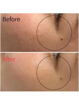 モアビューティー 紙屋町店/目元の小じわがすっきり!