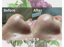 オーエスガーデン 帯広(OS Garden)/毛穴洗浄ハイドロスプラッシュ