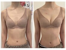 美人バスト 本厚木店/バストアップ◇症例◇