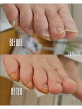 おん/コンプレックスな爪