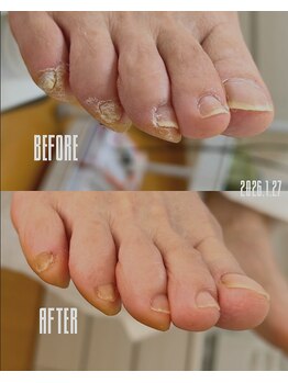 コンプレックスな爪