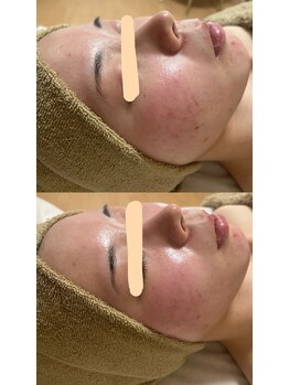 サロンモア(salon More)/ハーブピーリング