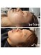 リーフィ 荻窪(Leafy)の写真/ハーブピーリングで肌質改善！ニキビ・毛穴・シミ・くすみ悩みを解消し、輝く透明肌へ導きます◎