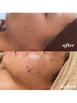 ベル(belle)/肌トラブルケア