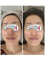 サロンエム 西荻窪(salon M) 炭酸ガスパックと美顔器でフェイシャル、一度でトーンアップ♪
