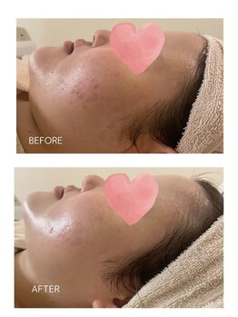 エモベーシック(e'MO BASIC)/1ヶ所12shot打ち込む最強フォト