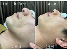 ヘアーピース(hair peace)の雰囲気（ヒゲ脱毛＋肌質改善でコンプレックス解消！メンズに大人気！）