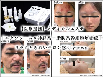 悠羽(yuuwa)/美容液導入