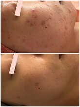 プレジール(Plaisir)/人気No. 1サーマ＋ララピ-ル+LDM