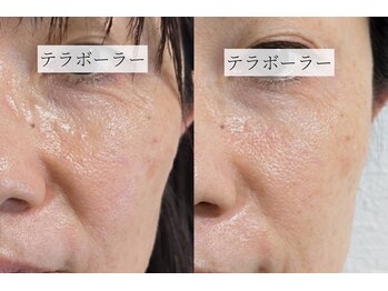 ディオーネ 岡崎店(Dione)/《テラボーラー》Before-After
