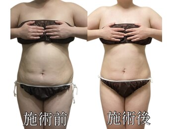 エリクシア 松戸/30代全身痩身２０回目お腹と背中