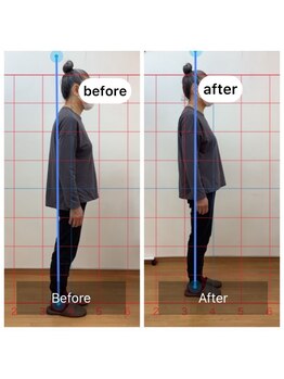 朱雀整骨院/姿勢矯正before after