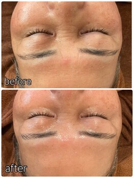 バンブー(bamboo)/インジェクションフェイシャル