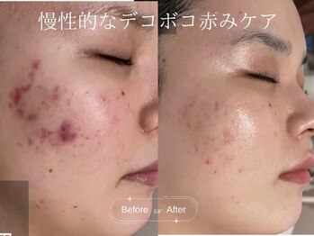 サロンドシー(SALON DE C)/繰り返す慢性的なニキビケア