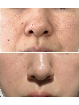 ユマニ バイ ヒート(Humani by HEAT)/ララピールとラレステンで肌育♪