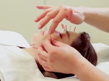 すみれ鍼灸整骨院/整体院の雰囲気(人気の美容鍼!たるみ、くすみ、はりのお悩みがある方おすすめ!)