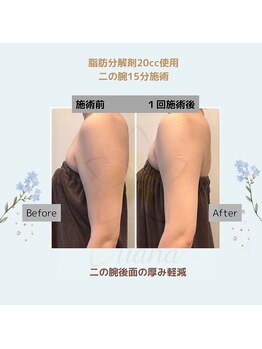 ルアナ(Luana)/脂肪分解＆燃焼！引き締めケア