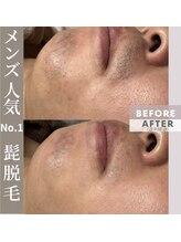 エステ リラクゼーションサロン(more)/【男性】ヒゲ光脱毛
