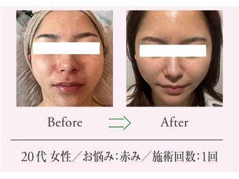 エステプロ ラボ 自由が丘/Before→After