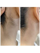 キアラ 麻布十番(Kiara)/うなじ脱毛麻布十番/毛穴/顔脱毛