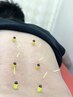 デスクワークで頸肩限界の３０～４０代向けに鍼灸+整体