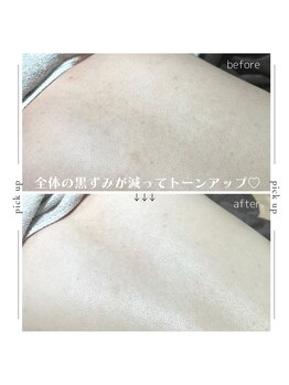 ファウンデーション(FOUNDATION)/背中ケア♪