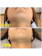 モモハダ(momo hada)/ヒゲ脱毛経過写真　2回後