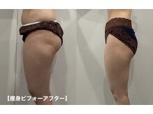 ヴィノス(Vinos)/痩身エステ下着併用×ホームケア